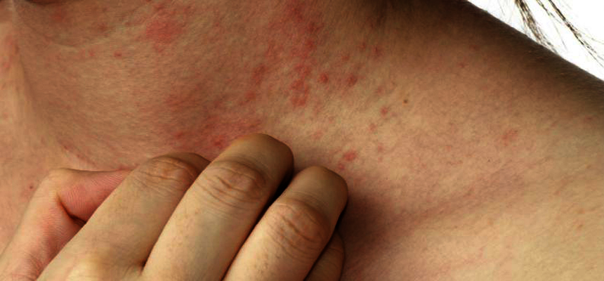 CONTROLLING WINTER RASHES