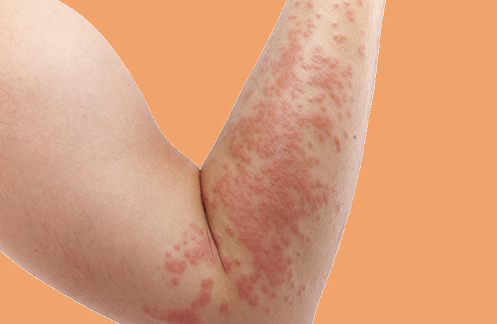 HANDLING HIVES