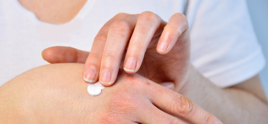 Prevention of dry skin in winter 