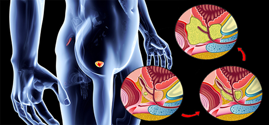 Know the Signs of Prostate Cancer and How to Cure It