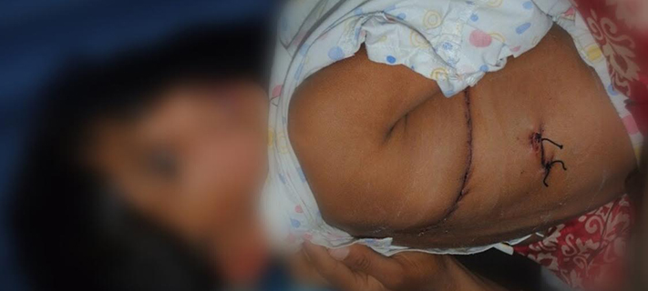 Heart Surgery performed on a 9 year old through back