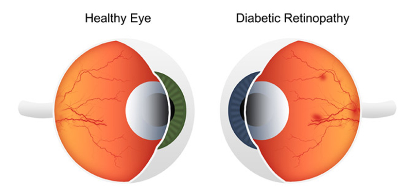 Keep an Eye on Diabetes 