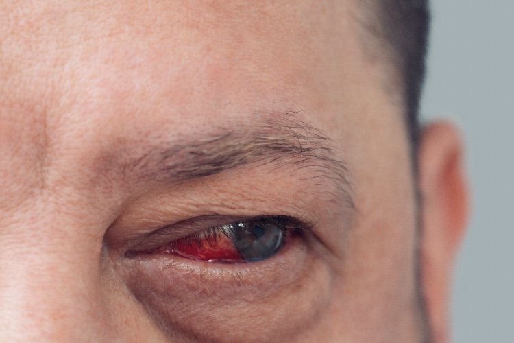 SJOGREN’S – DIAGNOSIS AND TREATMENT